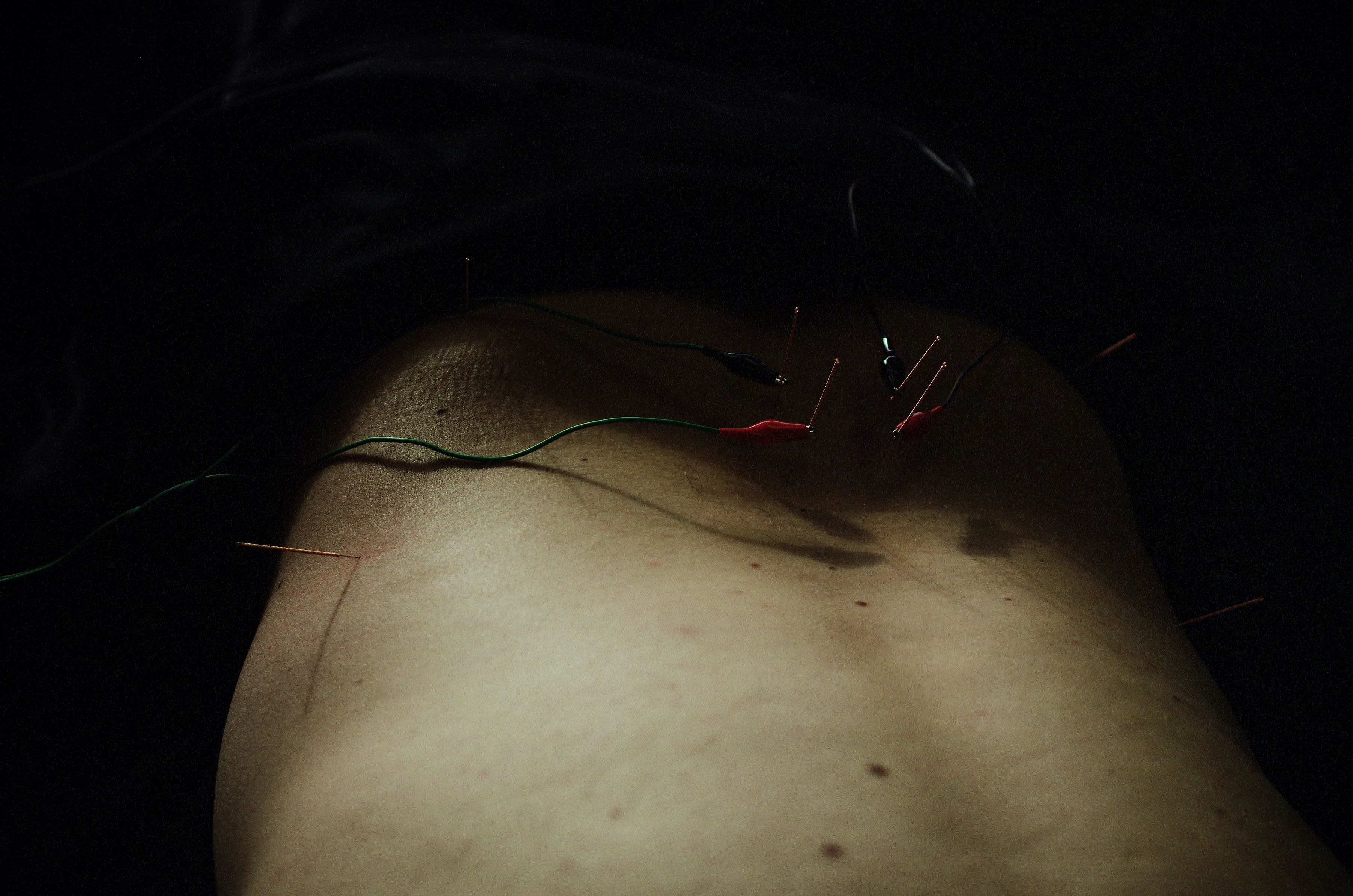 Pain and injury acupuncture treatment Sherwood Park
