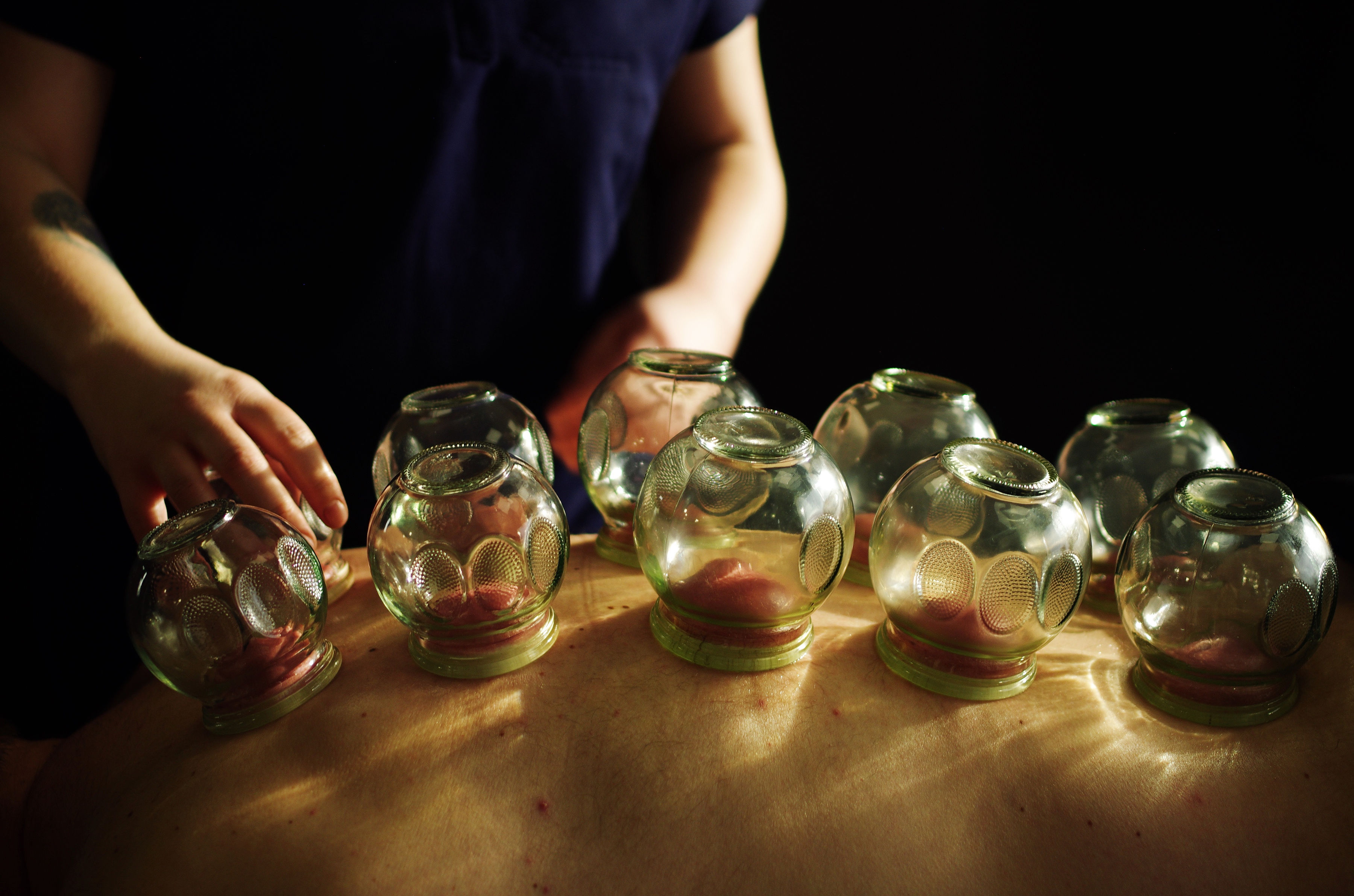 Cupping therapy Sherwood Park