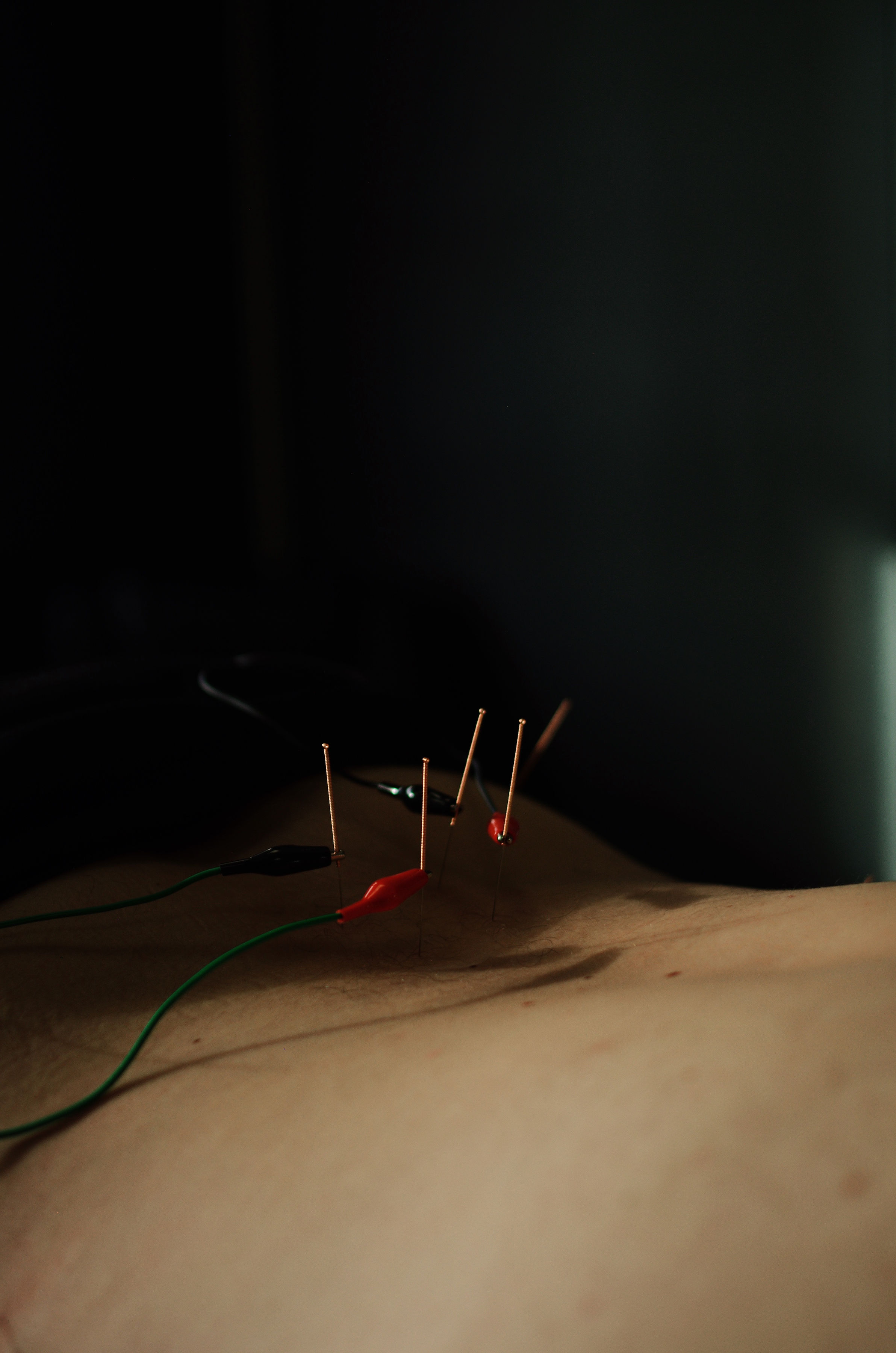 Electro acupuncture Sherwood Park