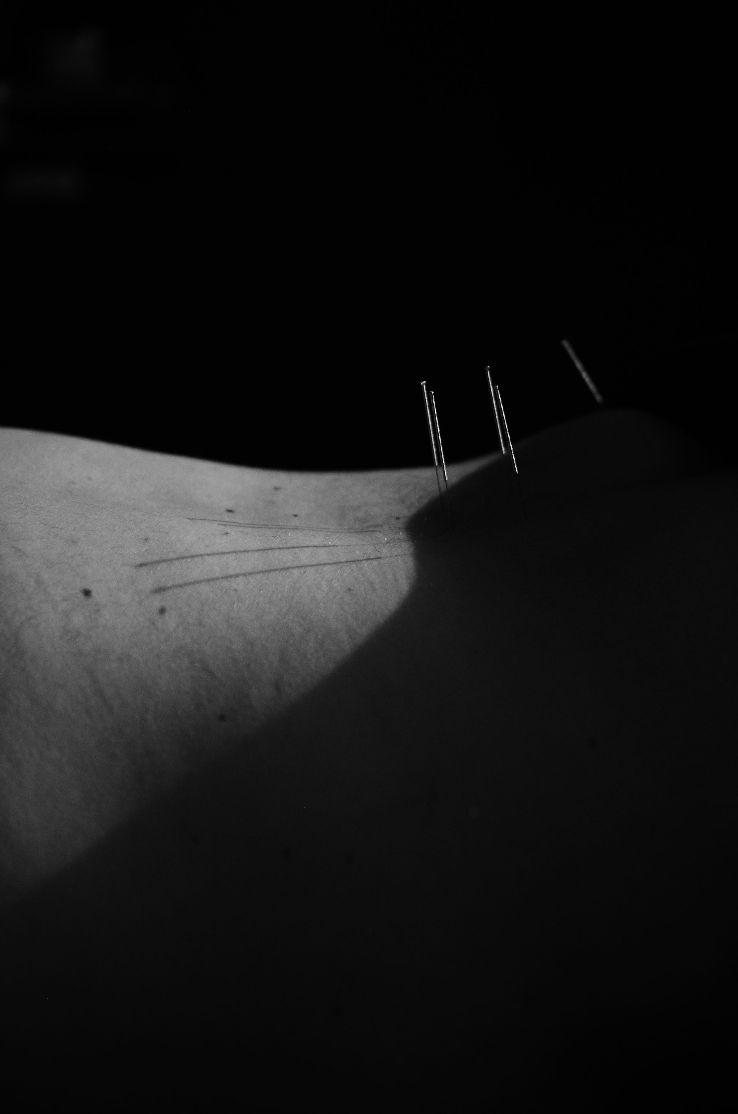 Sport acupuncture Sherwood Park